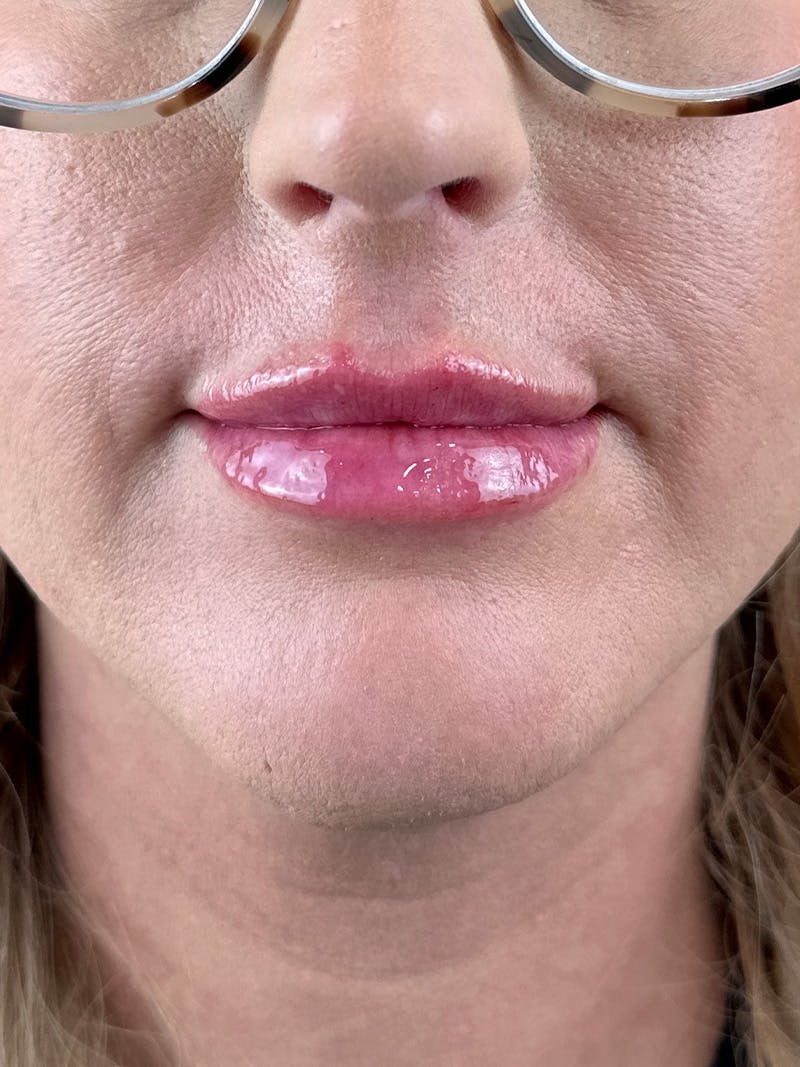 Lip Filler Before & After Gallery - Patient 384971 - Image 2