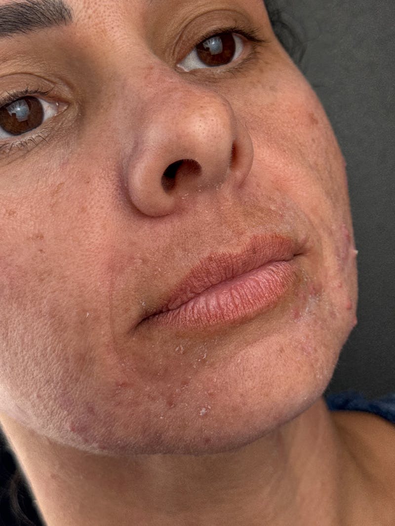 Lip Filler Before & After Gallery - Patient 321219 - Image 1