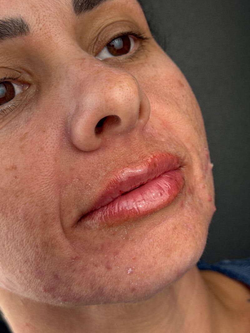 Lip Filler Before & After Gallery - Patient 321219 - Image 2