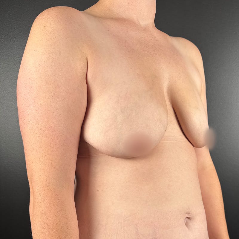 Breast Lift w/Fat Grafting Before & After Gallery - Patient 357683 - Image 3