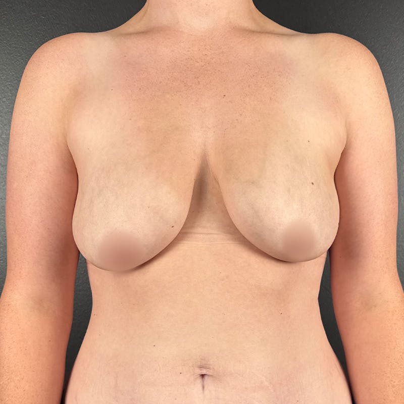 Breast Lift w/Fat Grafting Before & After Gallery - Patient 357683 - Image 1