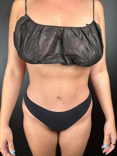 Tummy Tuck Before & After Gallery - Patient 264071 - Image 2