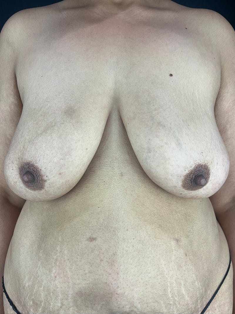 Breast Lift with Implants Before & After Gallery - Patient 104929 - Image 1