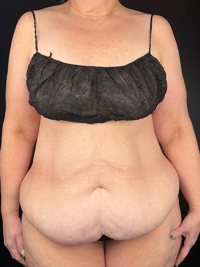 Tummy Tuck Before & After Gallery - Patient 298026 - Image 1