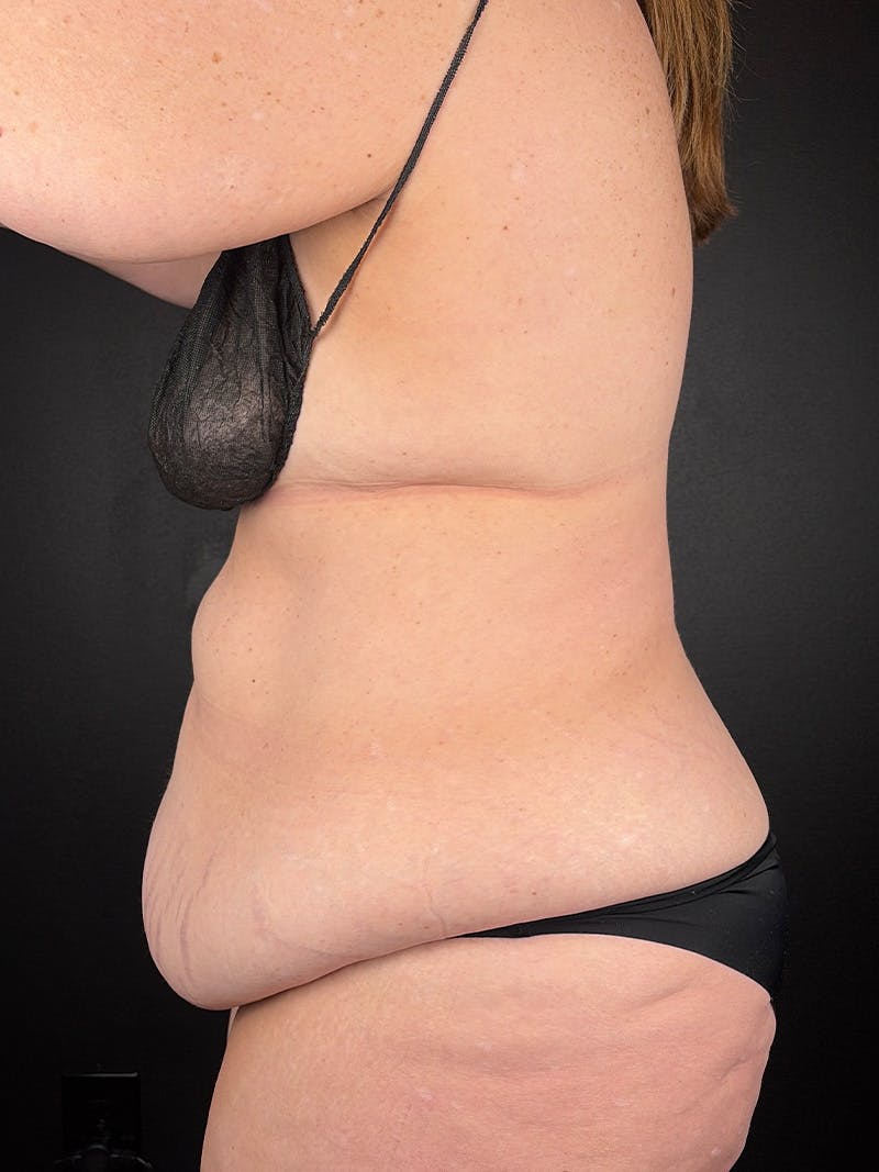 Tummy Tuck Before & After Gallery - Patient 298026 - Image 3