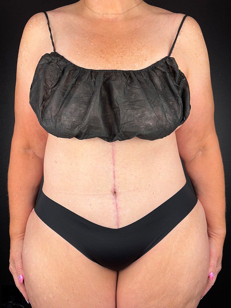 Tummy Tuck Before & After Gallery - Patient 298026 - Image 2