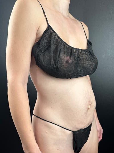 Tummy Tuck Before & After Gallery - Patient 337742 - Image 1