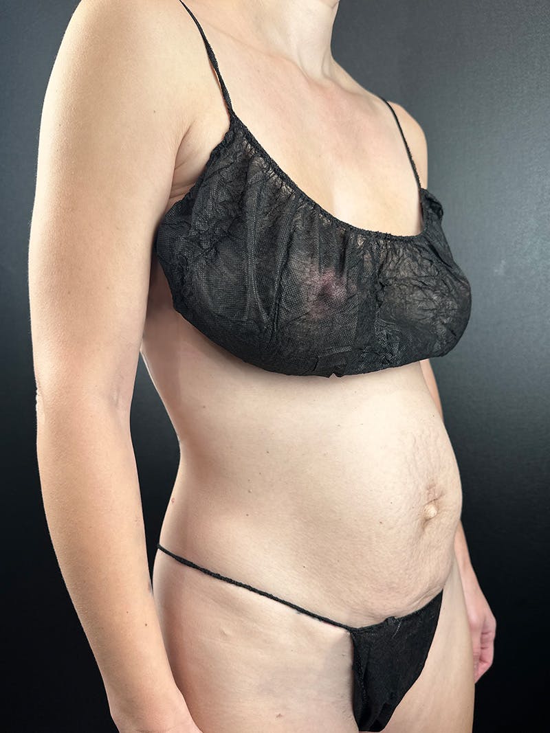 Tummy Tuck Before & After Gallery - Patient 337742 - Image 1