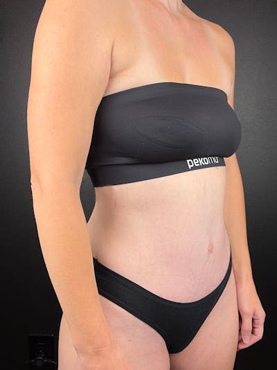 Tummy Tuck Before & After Gallery - Patient 337742 - Image 2