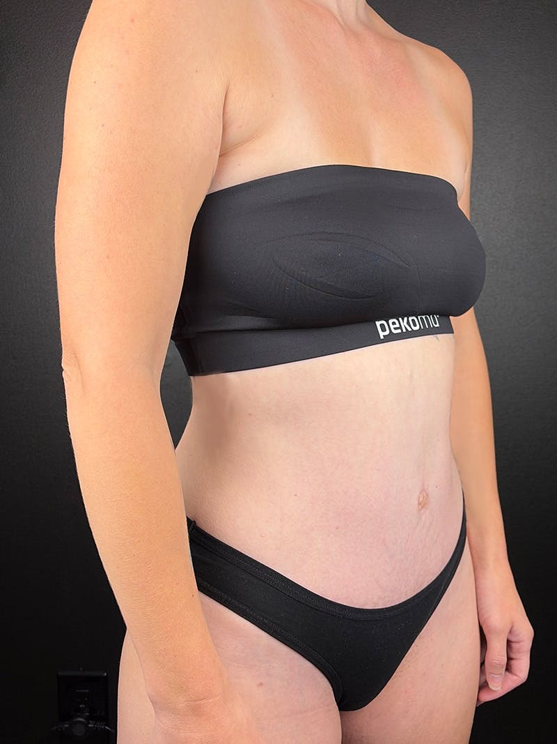 Tummy Tuck Before & After Gallery - Patient 337742 - Image 2