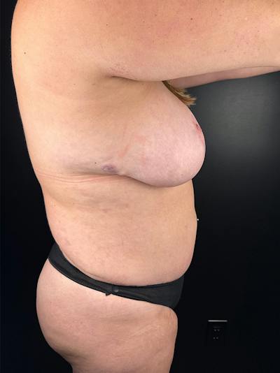 Abdomen (Liposuction) Before & After Gallery - Patient 904934 - Image 1