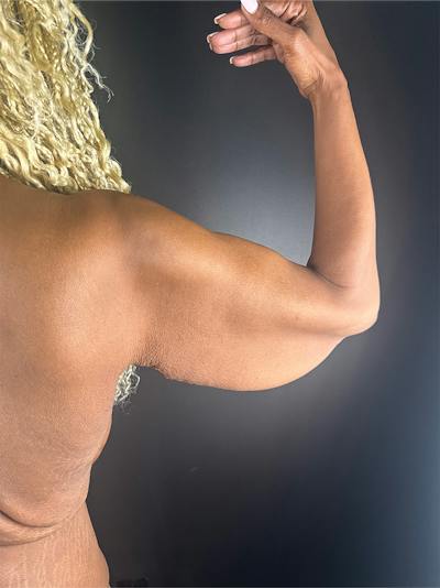 Arm Lift Before & After Gallery - Patient 422566 - Image 1