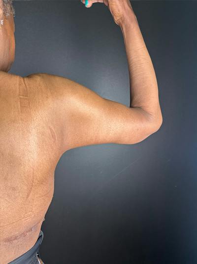 Arm Lift Before & After Gallery - Patient 422566 - Image 2