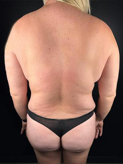 Back (Liposuction) Before & After Gallery - Patient 327158 - Image 1
