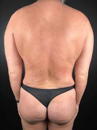 Back (Liposuction) Before & After Gallery - Patient 327158 - Image 2