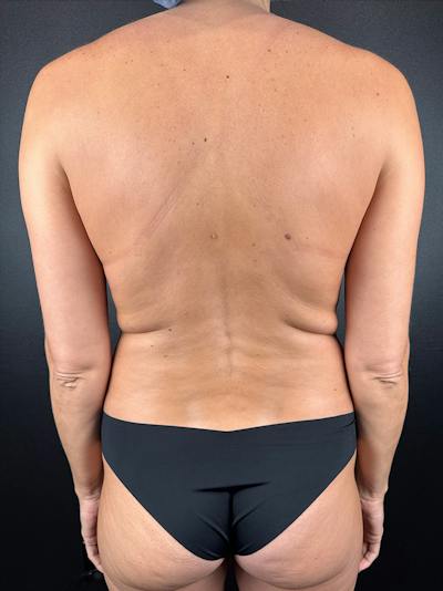 Back (Liposuction) Before & After Gallery - Patient 173690 - Image 1