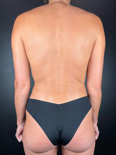 Back (Liposuction) Before & After Gallery - Patient 173690 - Image 2