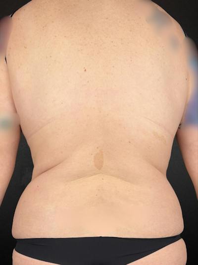 Back (Liposuction) Before & After Gallery - Patient 233082 - Image 1