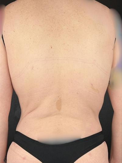 Back (Liposuction) Before & After Gallery - Patient 233082 - Image 2