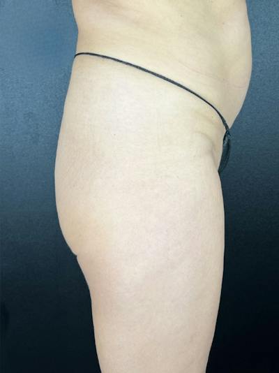 BBL + Aveli  Before & After Gallery - Patient 199231 - Image 1