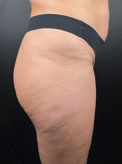 BBL + Aveli  Before & After Gallery - Patient 199231 - Image 2