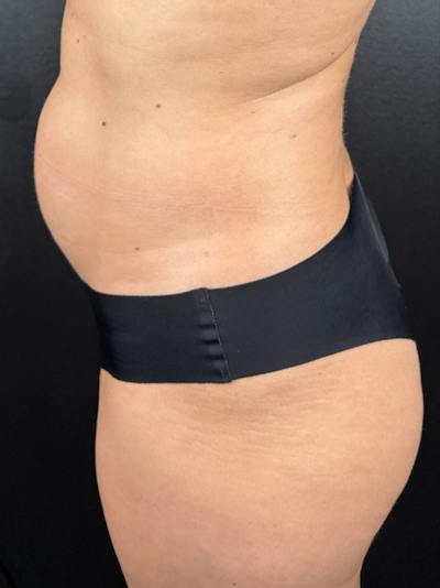 BBL + Aveli  Before & After Gallery - Patient 193780 - Image 1