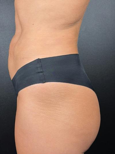 BBL + Aveli  Before & After Gallery - Patient 193780 - Image 2