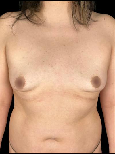 Breast Augmentation Before & After Gallery - Patient 365045 - Image 1