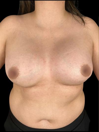 Breast Augmentation Before & After Gallery - Patient 365045 - Image 2