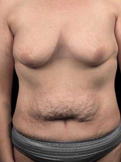 Breast Lift with Implants Before & After Gallery - Patient 581939 - Image 1