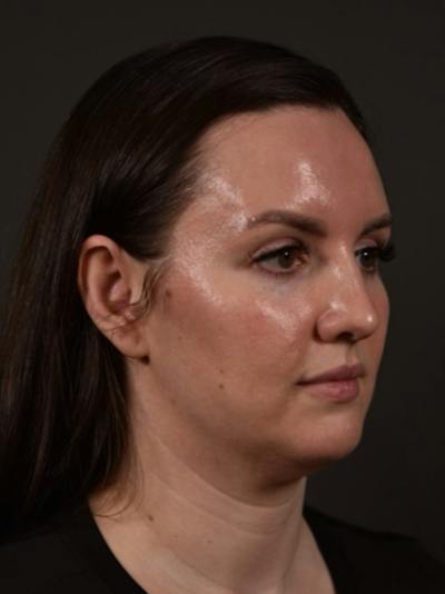 FaceTite Before & After Gallery - Patient 313406 - Image 1