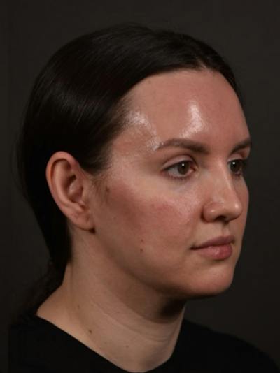 FaceTite Before & After Gallery - Patient 313406 - Image 2