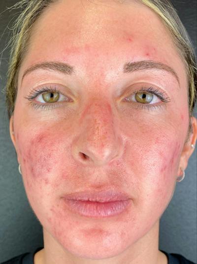 IPL Before & After Gallery - Patient 501245 - Image 1