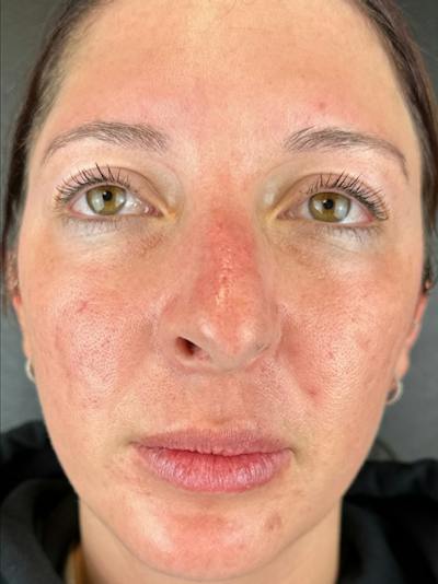 IPL Before & After Gallery - Patient 501245 - Image 2