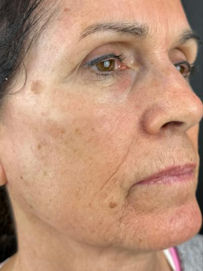 IPL Before & After Gallery - Patient 410194 - Image 1