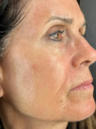 IPL Before & After Gallery - Patient 410194 - Image 2