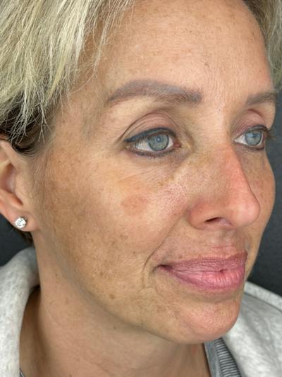 IPL Before & After Gallery - Patient 417436 - Image 1
