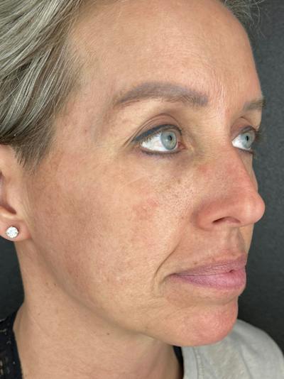 IPL Before & After Gallery - Patient 417436 - Image 2
