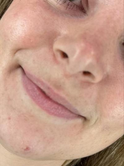 Lip Filler Before & After Gallery - Patient 265738 - Image 1