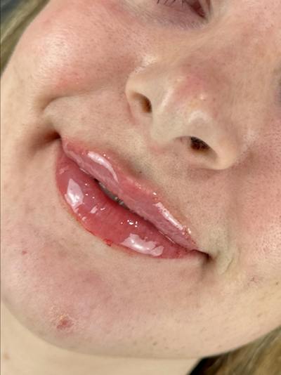 Lip Filler Before & After Gallery - Patient 265738 - Image 2
