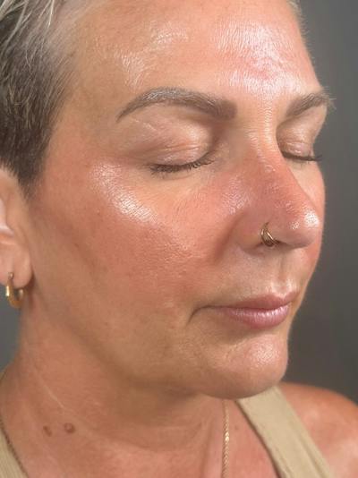 Lower Face Filler Before & After Gallery - Patient 258603 - Image 1