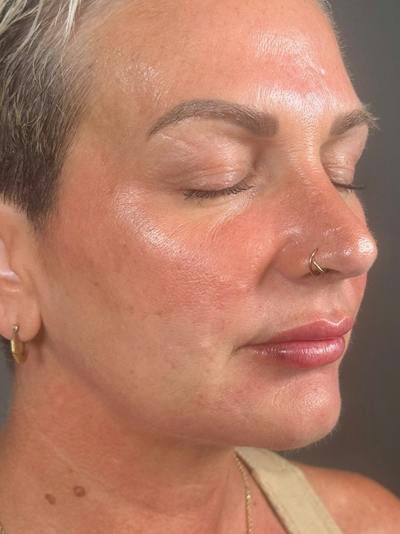 Lower Face Filler Before & After Gallery - Patient 258603 - Image 2