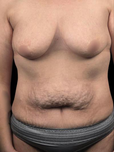 Tummy Tuck Before & After Gallery - Patient 314060 - Image 1