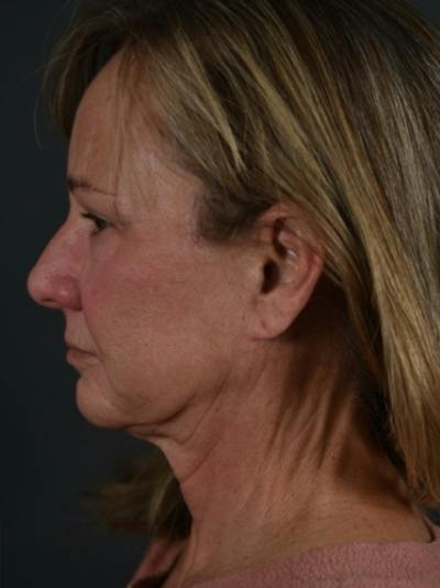 Neck Lift Before & After Gallery - Patient 255085 - Image 1