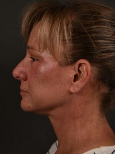 Neck Lift Before & After Gallery - Patient 255085 - Image 2