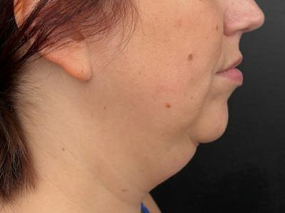  Neck/Submental Liposuction Before & After Gallery - Patient 145866 - Image 1
