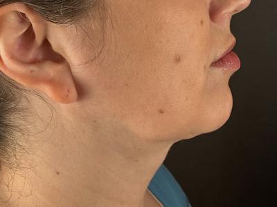  Neck/Submental Liposuction Before & After Gallery - Patient 145866 - Image 2
