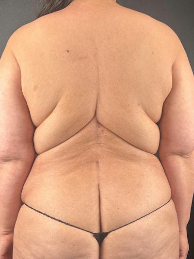 Upper Back Lift Before & After Gallery - Patient 368622 - Image 1