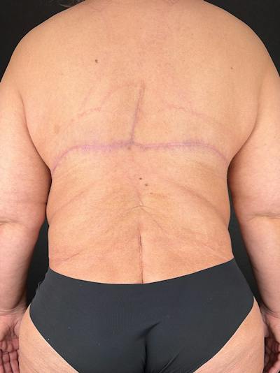 Upper Back Lift Before & After Gallery - Patient 368622 - Image 2