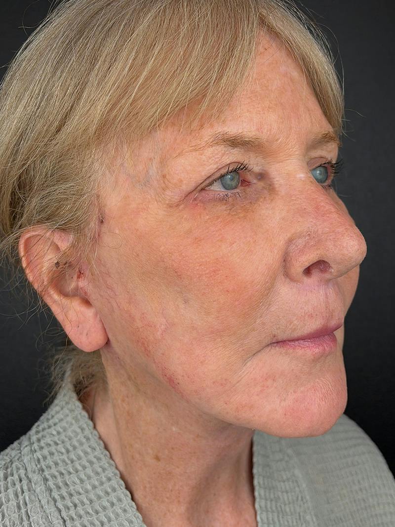 Neck Lift Before & After Gallery - Patient 296854 - Image 4